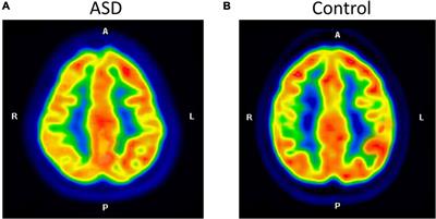 Brain laterality evaluated by F-18 fluorodeoxyglucose positron emission computed tomography in autism spectrum disorders